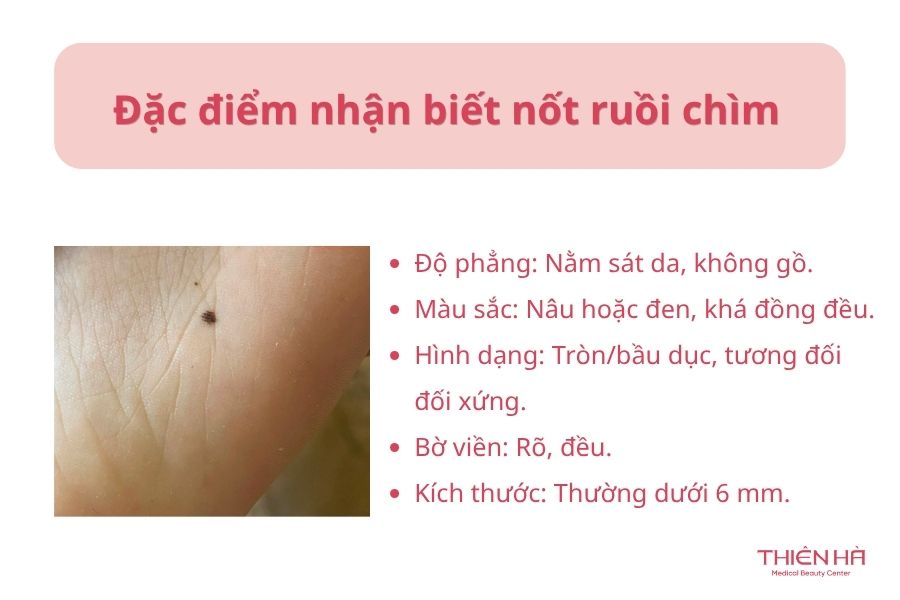 Đặc điểm nhận biết nốt ruồi chìm