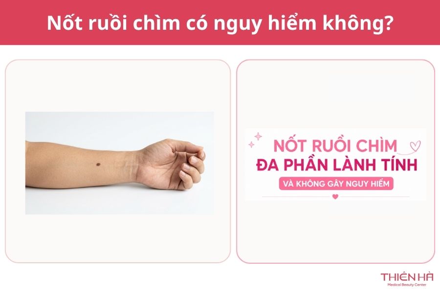 Nốt ruồi chìm có nguy hiểm không?