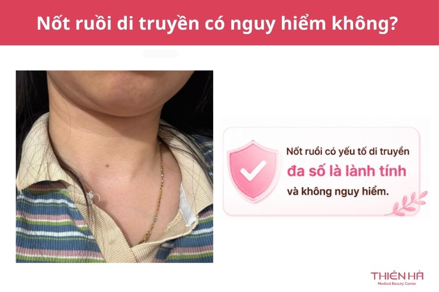 Nốt ruồi có di truyền không? Nguyên nhân và điều cần biết 5 Nốt ruồi di truyền có nguy hiểm không?