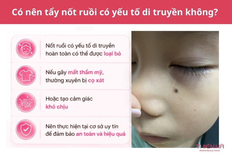 Nốt ruồi có di truyền không? Nguyên nhân và điều cần biết 6 Có nên tẩy nốt ruồi có yếu tố di truyền không?