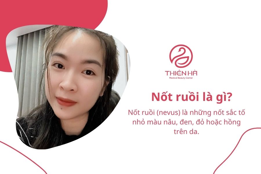 Nốt ruồi có di truyền không? Nguyên nhân và điều cần biết 1 Nốt ruồi là gì?