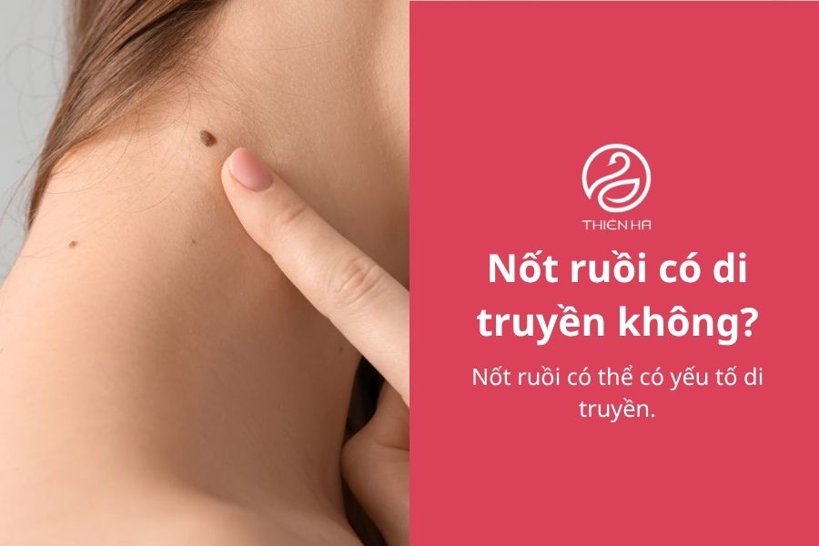 Nốt ruồi có di truyền không? Nguyên nhân và điều cần biết 2 Nốt ruồi có di truyền không?