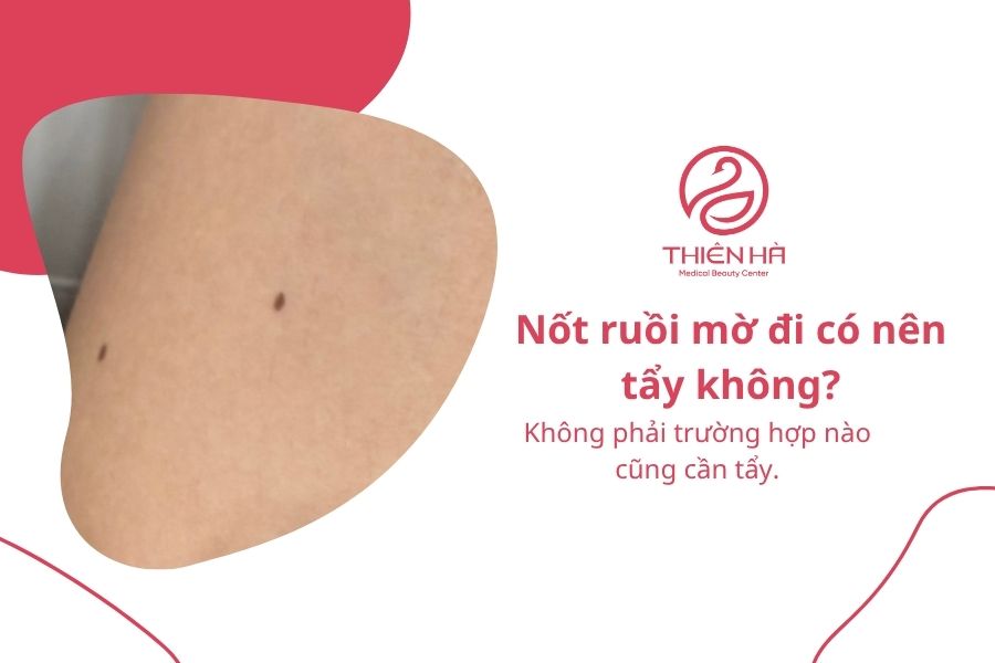 Câu hỏi thường gặp về nốt ruồi mờ đi