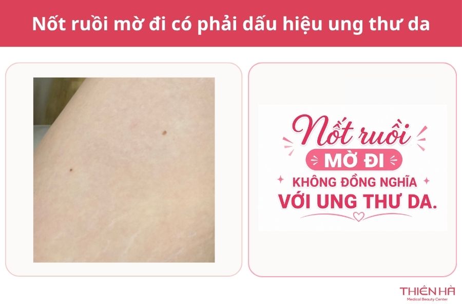 Nốt ruồi mờ đi có phải dấu hiệu ung thư da không?