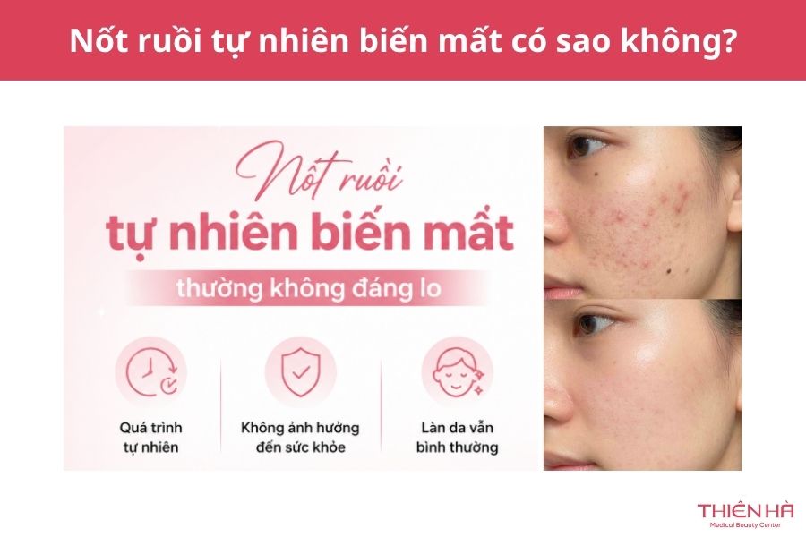 Nốt ruồi tự nhiên biến mất có sao không? 