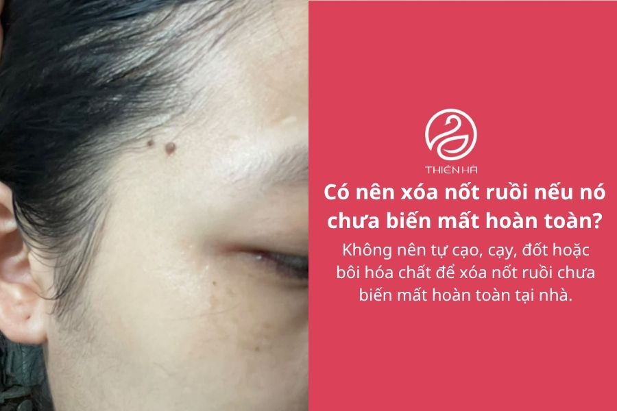 Có nên xóa nốt ruồi nếu nó chưa biến mất hoàn toàn?