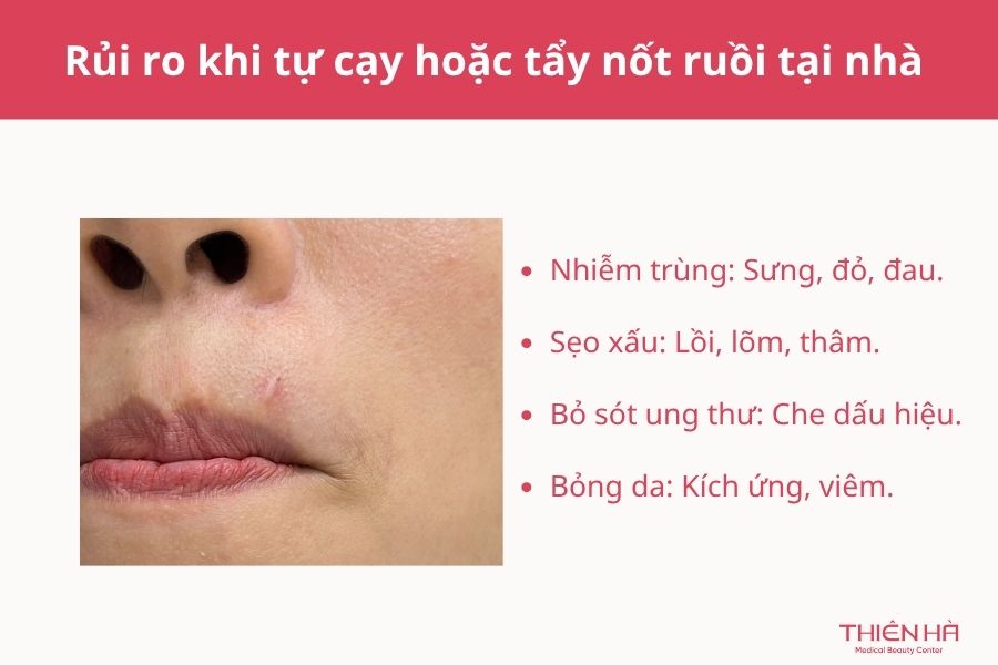 Rủi ro khi tự cạy hoặc tẩy nốt ruồi tại nhà 