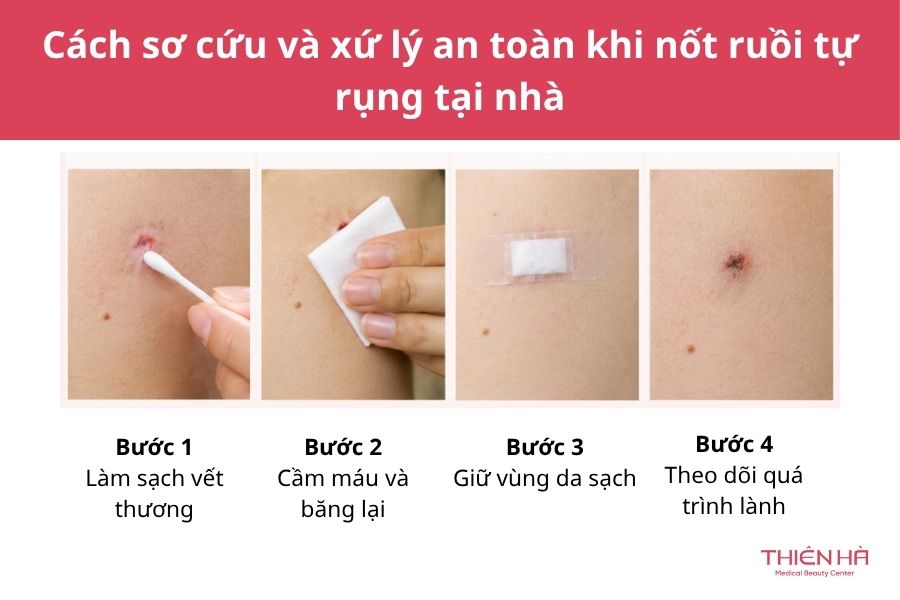Cách sơ cứu và xứ lý an toàn khi nốt ruồi tự rụng tại nhà