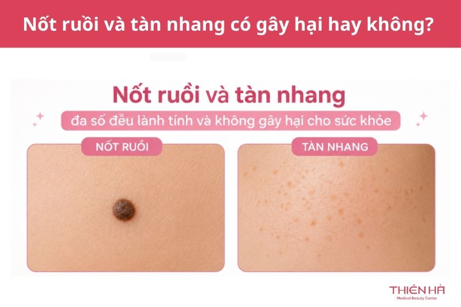Nốt ruồi và tàn nhang có gây hại hay không? 