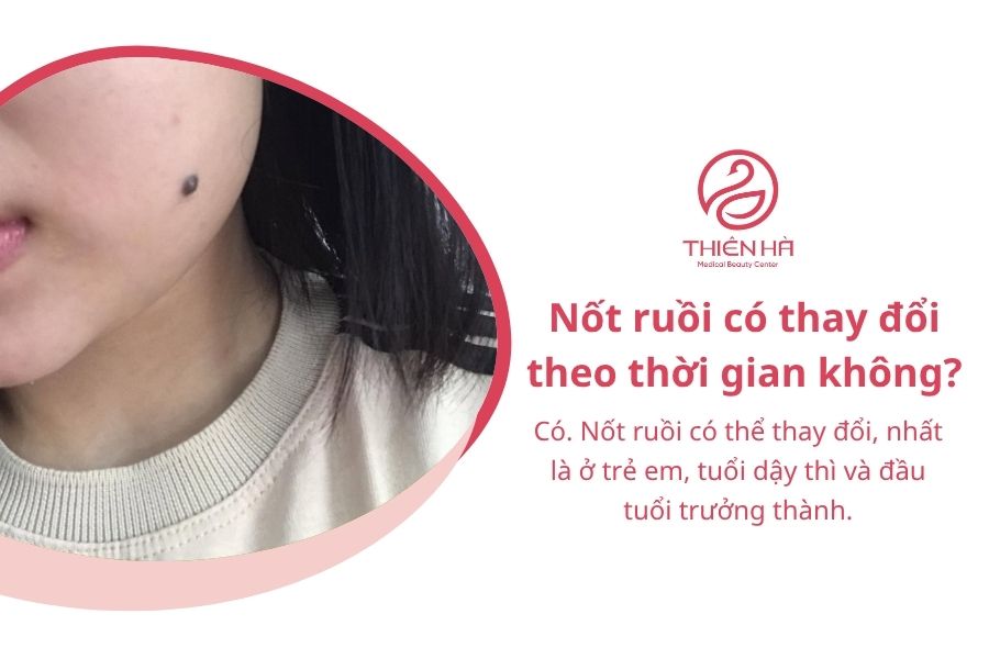 Nốt ruồi có thay đổi theo thời gian không?