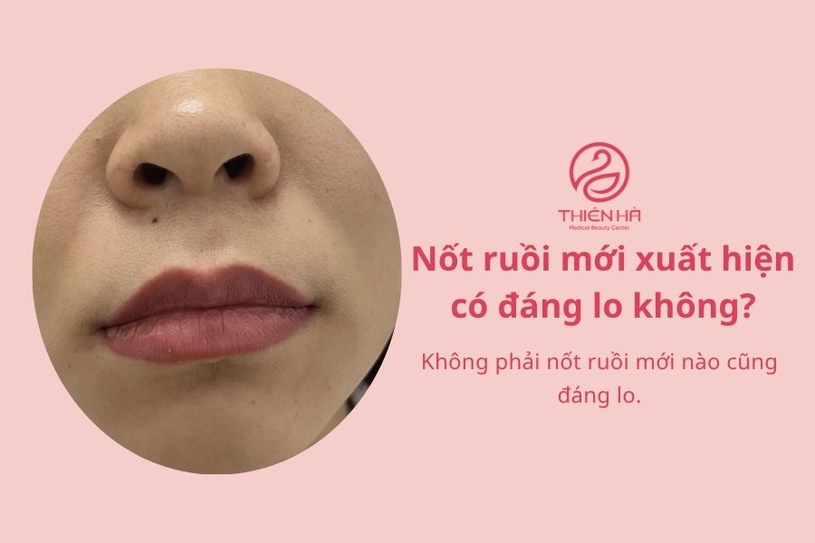 Câu hỏi thường gặp về nốt ruồi
