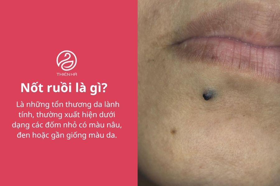 Nốt ruồi là gì? 