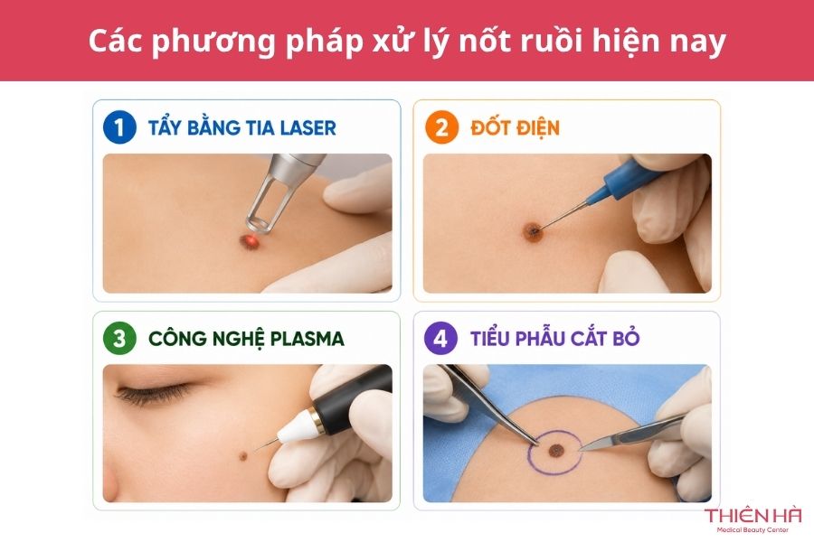 Các phương pháp xử lý nốt ruồi hiện nay