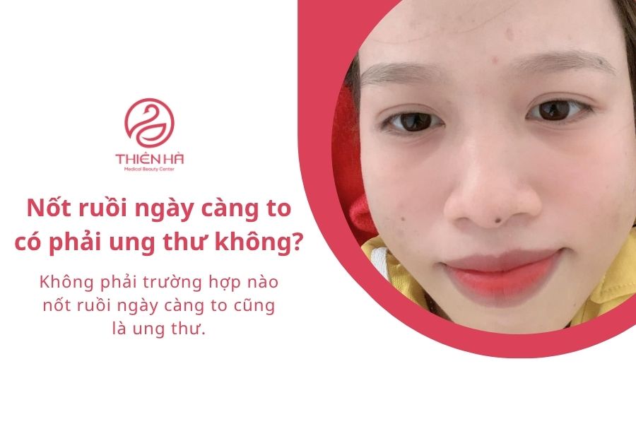 Tại sao nốt ruồi ngày càng to ra? Có nguy hiểm không? Xem ngay 6 Câu hỏi thường gặp về nốt ruồi ngày càng to ra