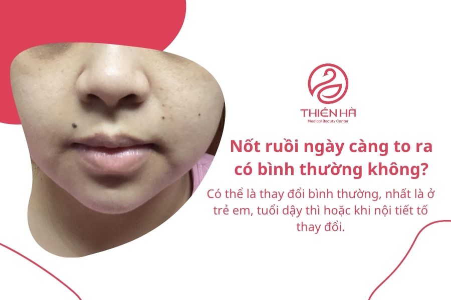 Tại sao nốt ruồi ngày càng to ra? Có nguy hiểm không? Xem ngay 1 Nốt ruồi ngày càng to ra có bình thường không?