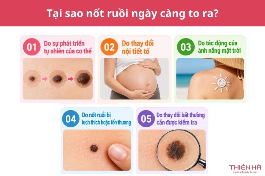 Tại sao nốt ruồi ngày càng to ra? Có nguy hiểm không? Xem ngay 2 Tại sao nốt ruồi ngày càng to ra?