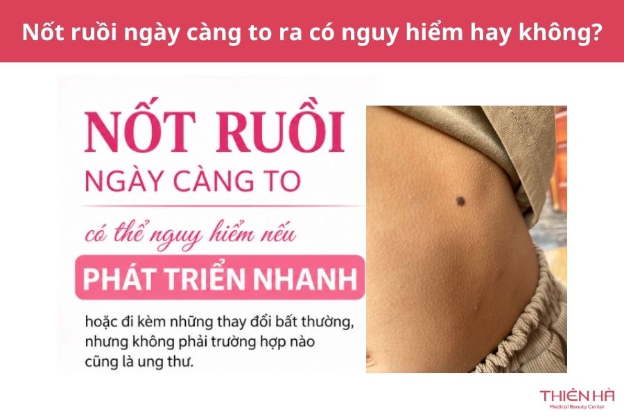 Tại sao nốt ruồi ngày càng to ra? Có nguy hiểm không? Xem ngay 3 Nốt ruồi ngày càng to ra có nguy hiểm không?