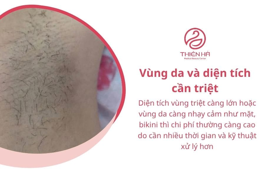 Bảng giá triệt lông mới nhất, chi tiết theo từng vùng 3 Vùng da và diện tích cần triệt là một trong các yếu tố quyết định triệt lông bao nhiêu tiền