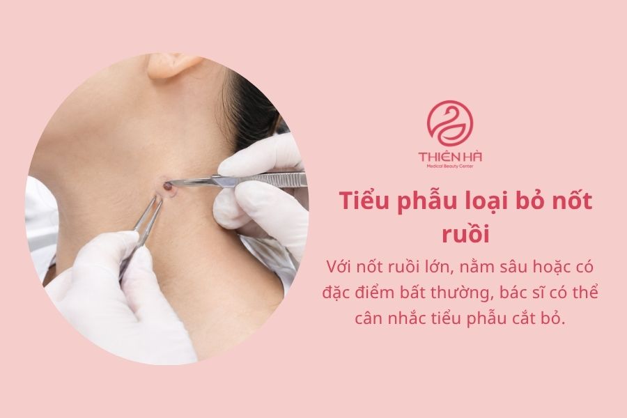 Cách xóa nốt ruồi bằng muối: Hướng dẫn và những rủi ro cần biết 6 Tiểu phẫu loại bỏ nốt ruồi