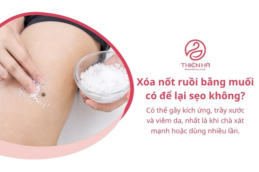 Cách xóa nốt ruồi bằng muối: Hướng dẫn và những rủi ro cần biết 8 Câu hỏi thường gặp về cách xóa nốt ruồi bằng muối