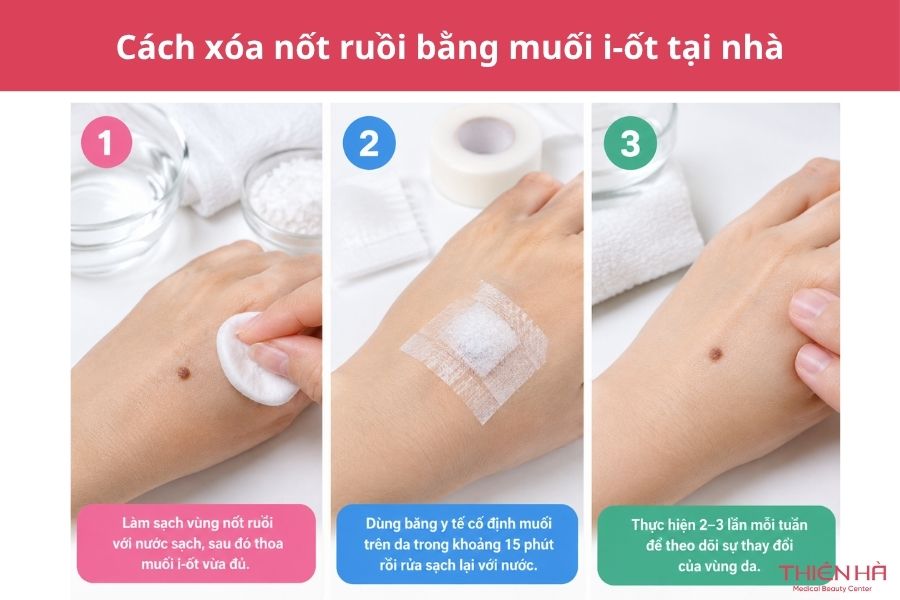 Cách xóa nốt ruồi bằng muối: Hướng dẫn và những rủi ro cần biết 2 Cách xóa nốt ruồi bằng muối i-ốt tại nhà