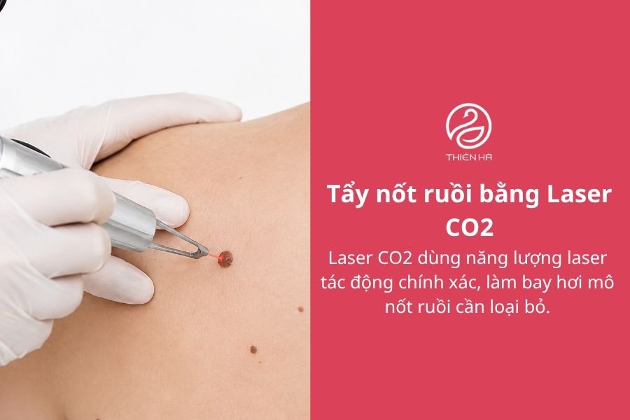 Cách xóa nốt ruồi bằng muối: Hướng dẫn và những rủi ro cần biết 4 Tẩy nốt ruồi bằng Laser CO2