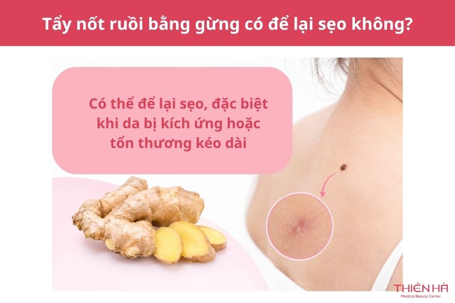 Cách tẩy nốt ruồi bằng gừng: Hướng dẫn và lưu ý quan trọng 8 Câu hỏi thường gặp về cách tẩy nốt ruồi bằng gừng