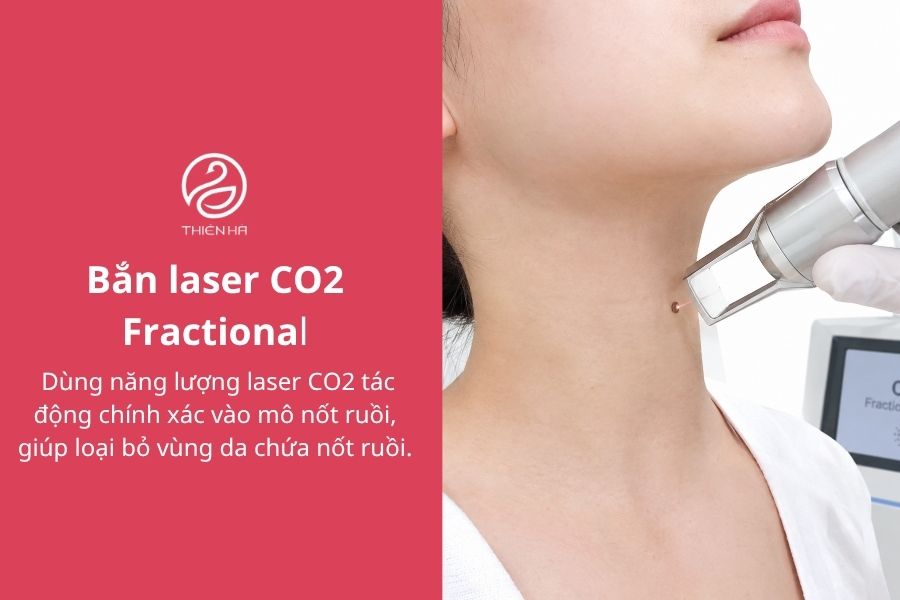 Cách tẩy nốt ruồi bằng gừng: Hướng dẫn và lưu ý quan trọng 5 Bắn laser CO2 Fractional