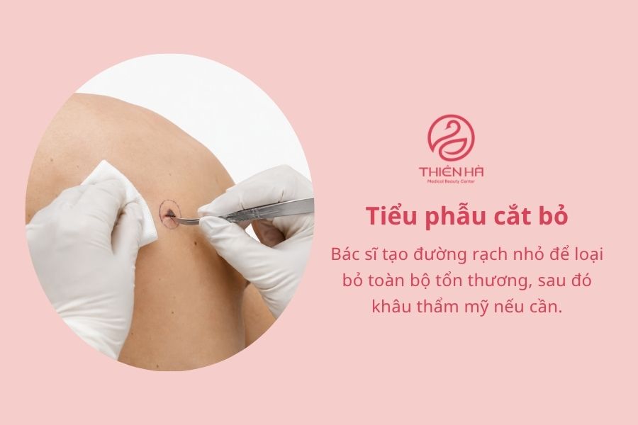 Cách tẩy nốt ruồi bằng gừng: Hướng dẫn và lưu ý quan trọng 6 Tiểu phẫu cắt bỏ