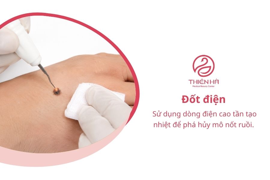 Cách tẩy nốt ruồi bằng gừng: Hướng dẫn và lưu ý quan trọng 7 Đốt điện