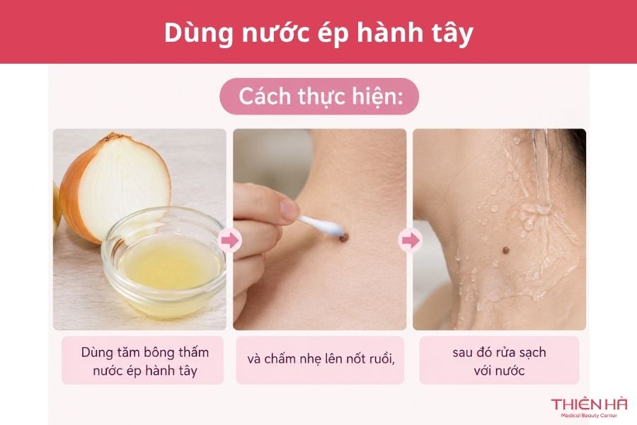 Cách tẩy nốt ruồi tại nhà: 6 cách phổ biến và điều cần biết 5 Dùng nước ép hành tây