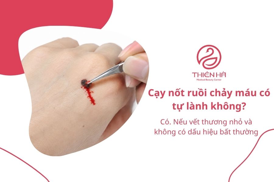 Cạy nốt ruồi chảy máu: Nguyên nhân, cách xử lý và khi nào khám 7 Câu hỏi thường gặp về cạy nốt ruồi chảy máu