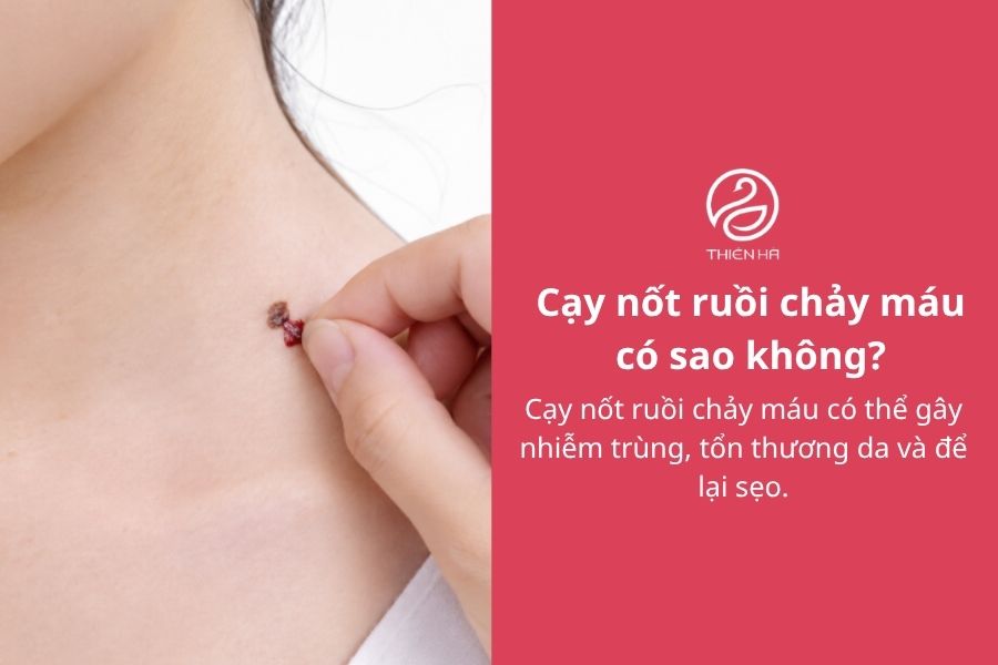 Cạy nốt ruồi chảy máu: Nguyên nhân, cách xử lý và khi nào khám 1 Cạy nốt ruồi chảy máu có sao không?