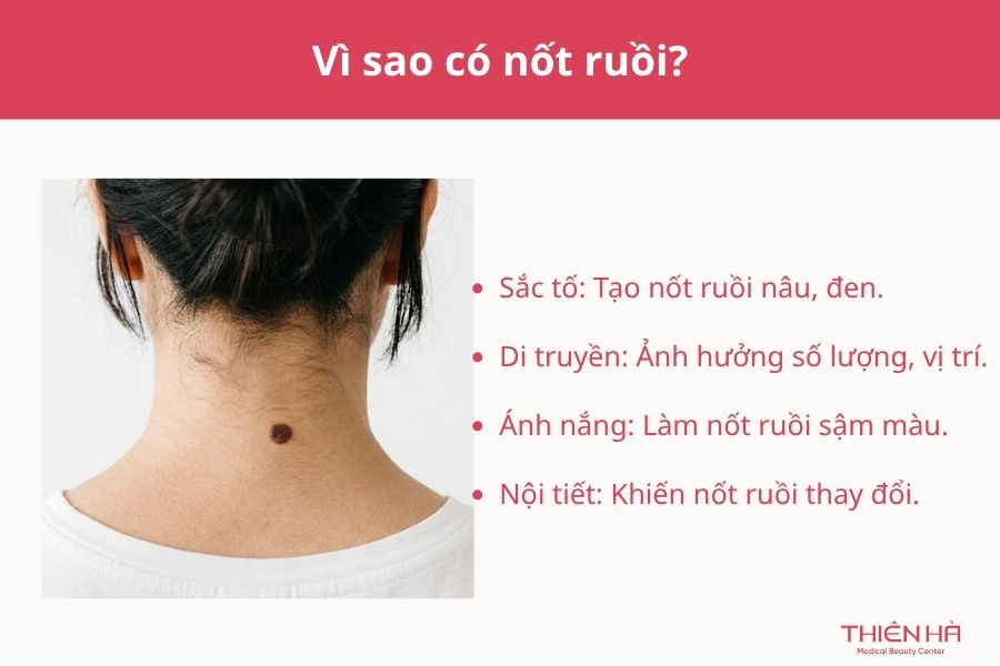 Vì sao có nốt ruồi? 