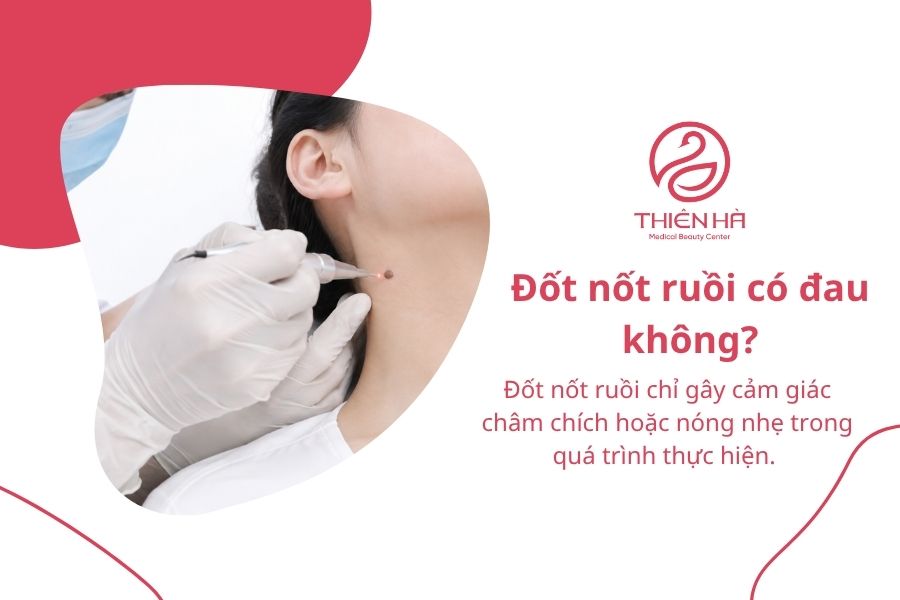 Câu hỏi thường gặp về đốt nốt ruồi