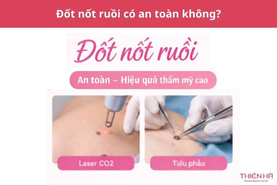 Đốt nốt ruồi có an toàn không?