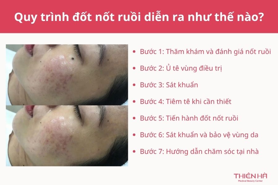 Quy trình đốt nốt ruồi diễn ra như thế nào?