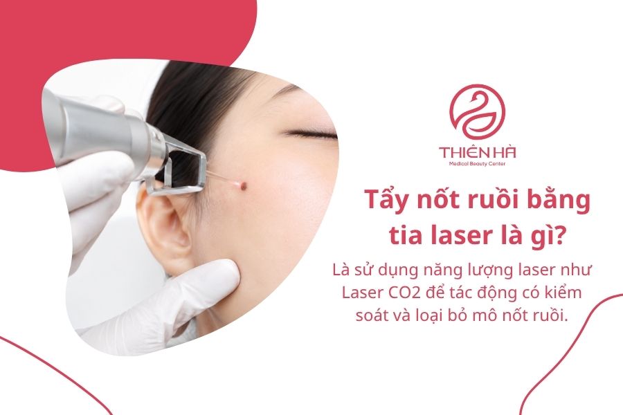 Tẩy nốt ruồi bằng tia laser là gì?