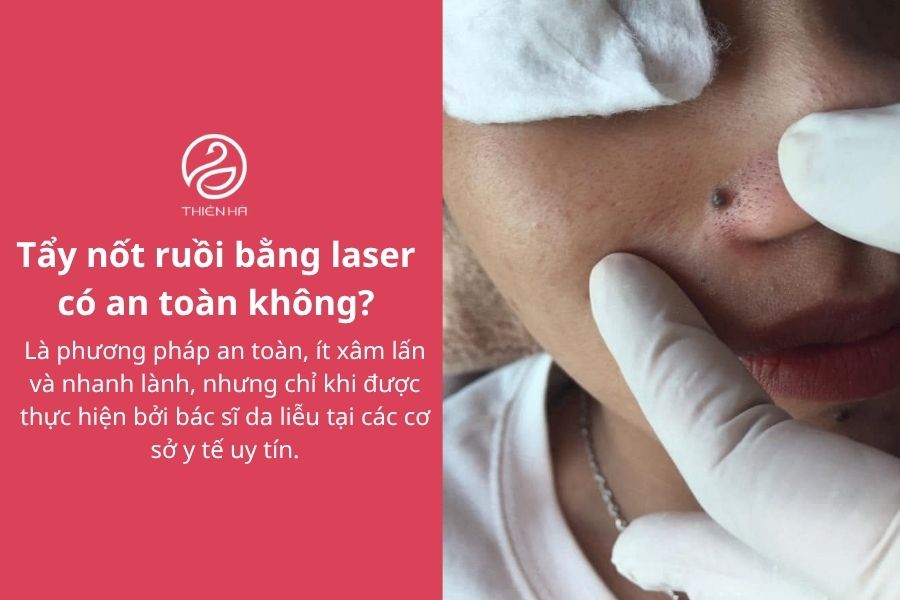 Tẩy nốt ruồi bằng laser có an toàn không?