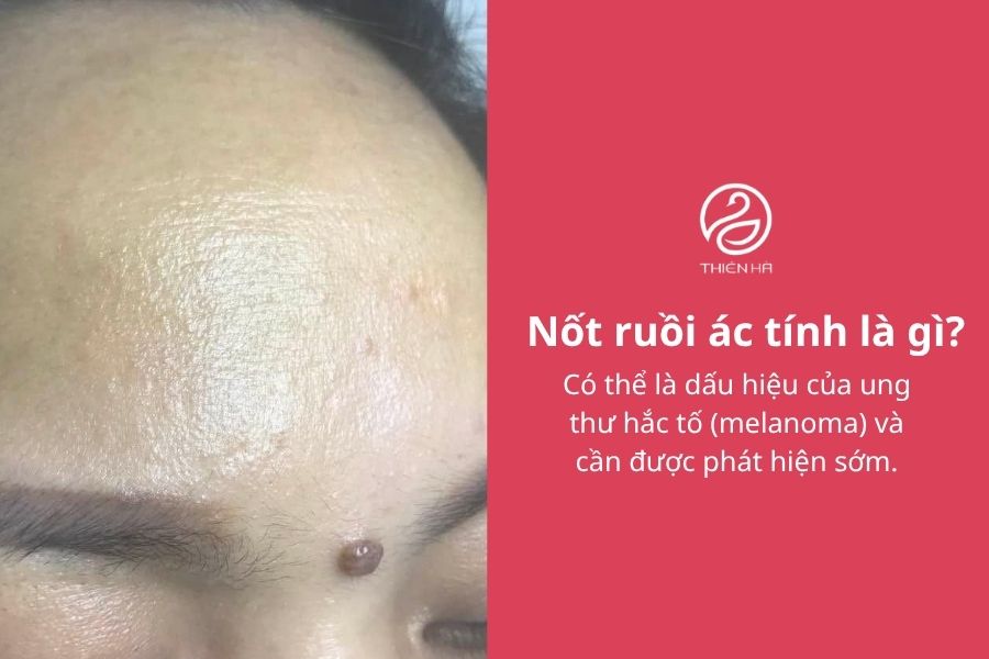 Nốt ruồi ác tính: Dấu hiệu nhận biết, nguy hiểm và cách xử lý 1 Nốt ruồi ác tính là gì?