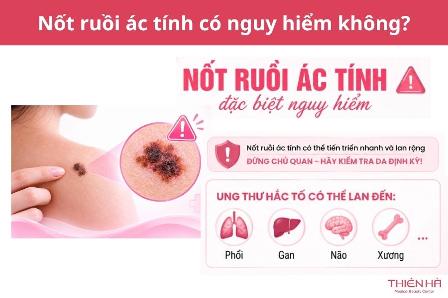 Nốt ruồi ác tính: Dấu hiệu nhận biết, nguy hiểm và cách xử lý 4 Nốt ruồi ác tính có nguy hiểm không?