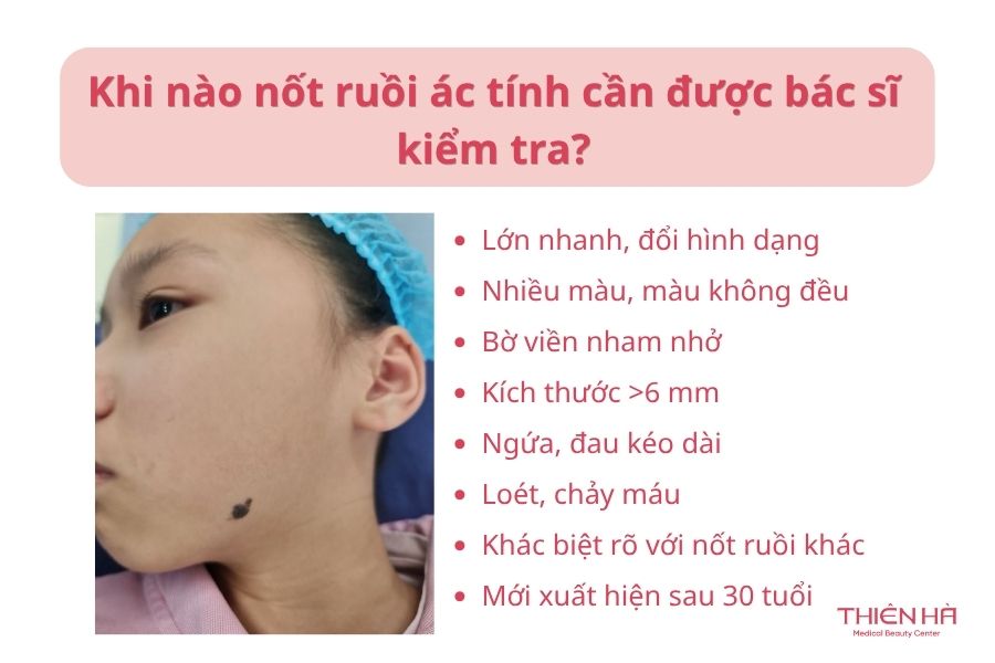 Nốt ruồi ác tính: Dấu hiệu nhận biết, nguy hiểm và cách xử lý 5 Khi nào nốt ruồi ác tính cần được bác sĩ kiểm tra?