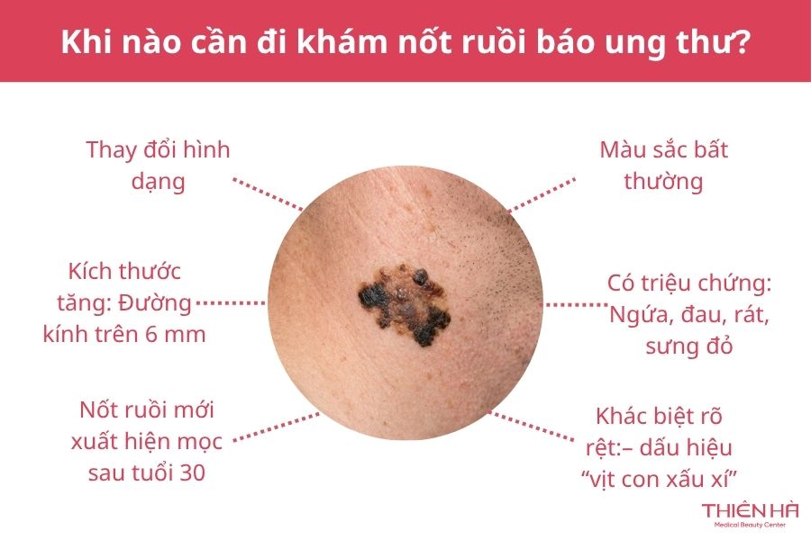 Nốt ruồi báo ung thư: Dấu hiệu nhận biết và khi nào cần khám 5 Khi nào cần đi khám nốt ruồi báo ung thư?