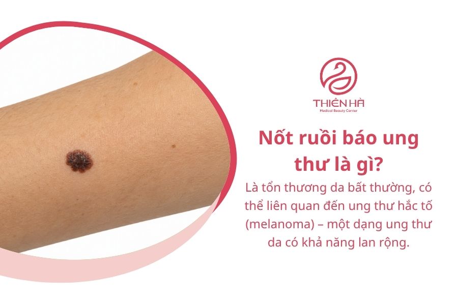 Nốt ruồi báo ung thư: Dấu hiệu nhận biết và khi nào cần khám 1 Nốt ruồi báo ung thư là gì?