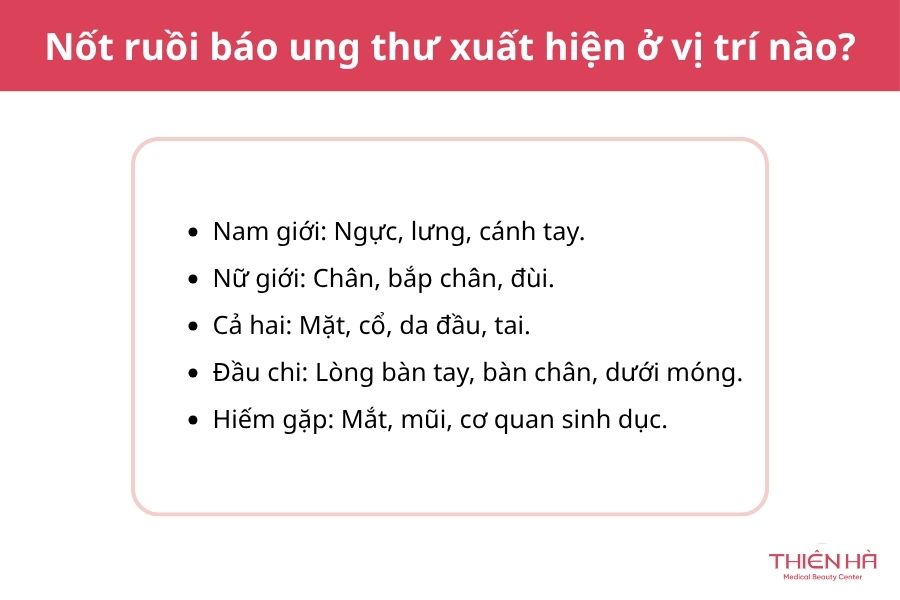 Nốt ruồi báo ung thư: Dấu hiệu nhận biết và khi nào cần khám 3 Nốt ruồi báo ung thư xuất hiện ở vị trí nào?