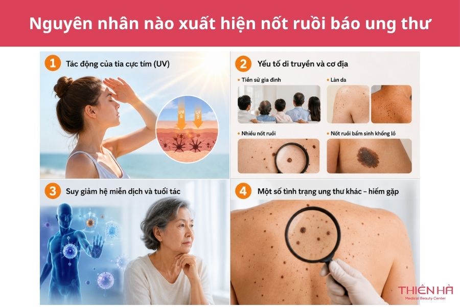 Nốt ruồi báo ung thư: Dấu hiệu nhận biết và khi nào cần khám 4 Nguyên nhân nào xuất hiện nốt ruồi báo ung thư?