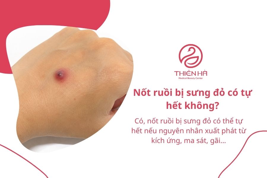 Nốt ruồi bị sưng đỏ: Vì sao xảy ra và khi nào cần đi khám? 7 Câu hỏi thường gặp về nốt ruồi bị sưng đỏ
