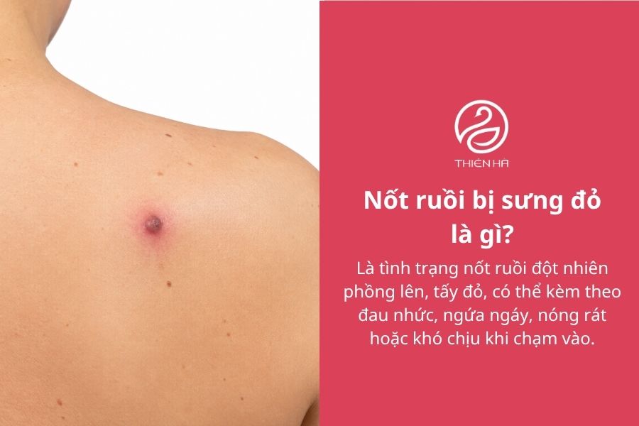 Nốt ruồi bị sưng đỏ: Vì sao xảy ra và khi nào cần đi khám? 1 Nốt ruồi bị sưng đỏ là gì?