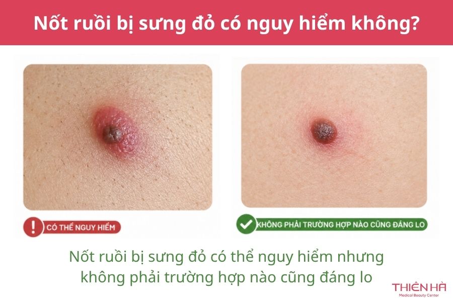 Nốt ruồi bị sưng đỏ: Vì sao xảy ra và khi nào cần đi khám? 3 Nốt ruồi bị sưng đỏ có nguy hiểm không?