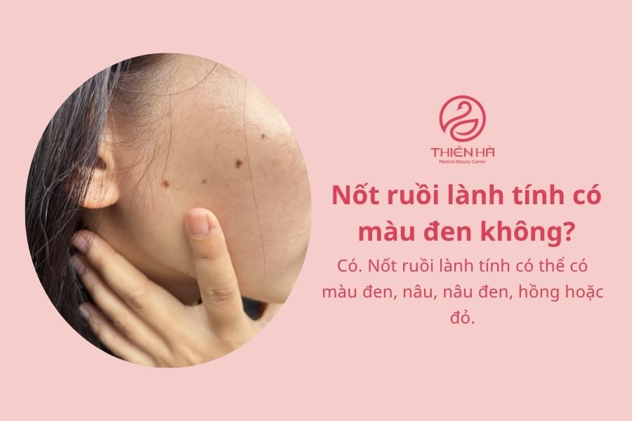 Nốt ruồi lành tính: Phân biệt với ác tính và cách xử lý đúng 8 Câu hỏi thường gặp về nốt ruồi lành tính